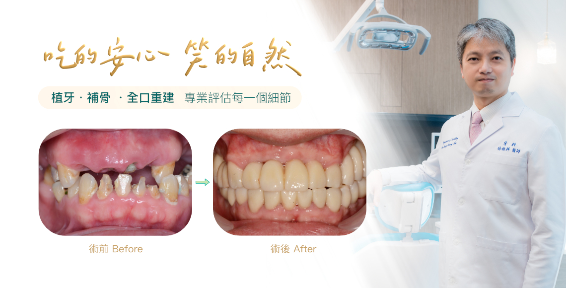 這些植牙困難，你可能也正在面對