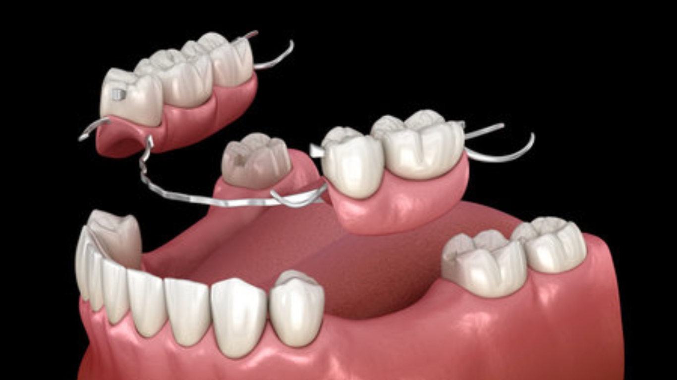 正式活動假牙製作流程 - 全口重建贋復假牙科 林正忠醫師